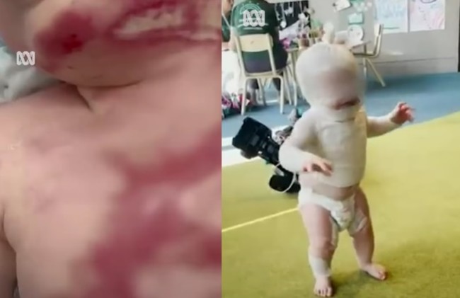 이제 10개월 된 루카는 가슴, 목, 얼굴에 심각한 화상을 입었으며, 여러 차례의 수술을 받아야 했다.